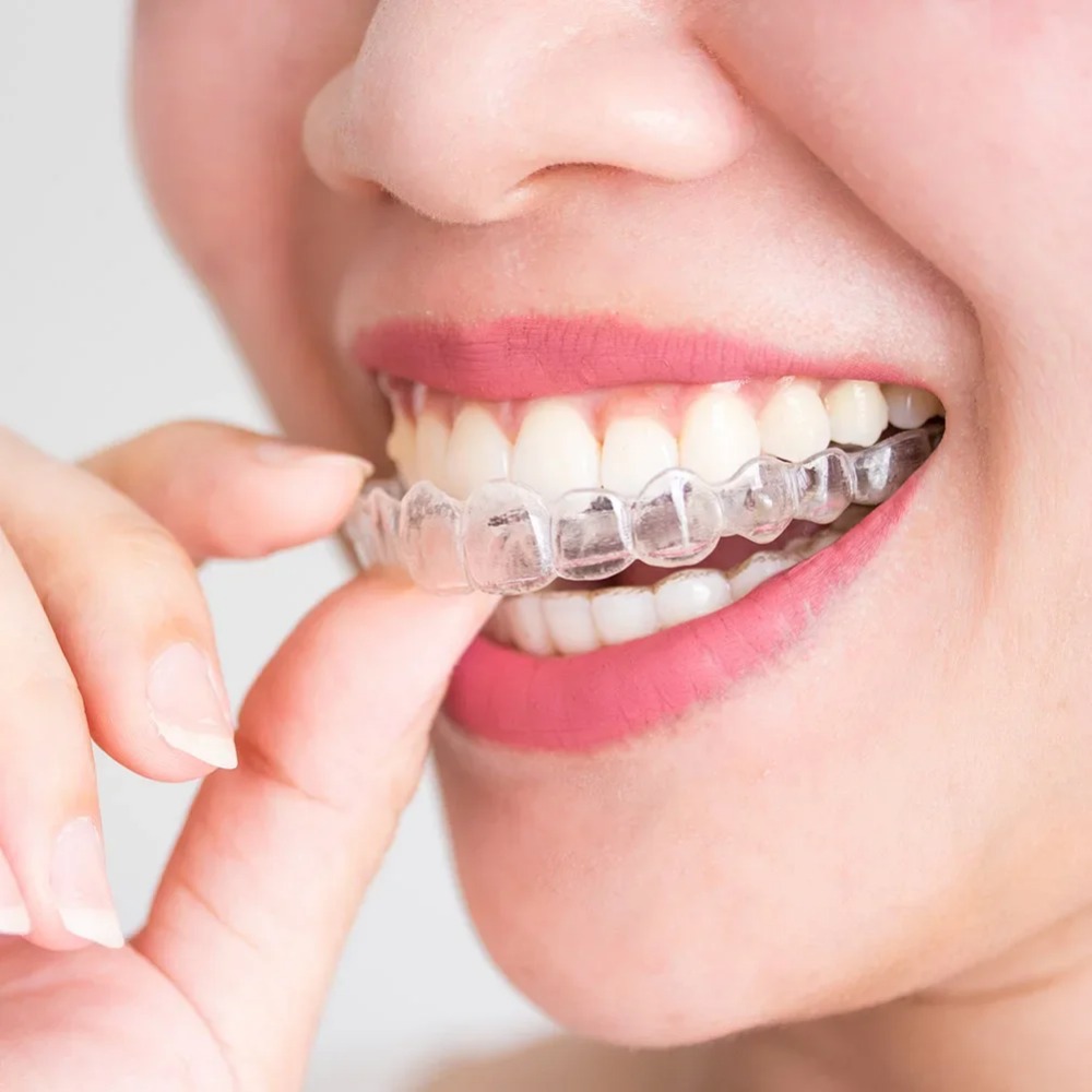 1-4個入りいびき防止歯ぎしり防止睡眠用マウスガードトレイ、 - Dental Guard Night のレビューと価格