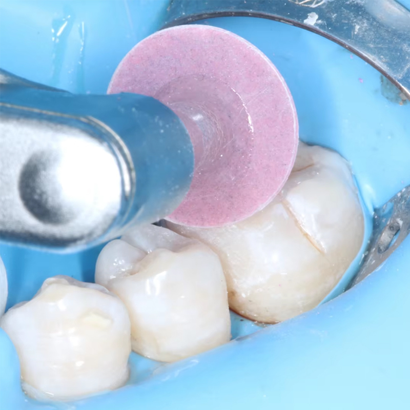 40個入り歯科研磨ディスク、コンポジットレジン仕上げ研磨ステ - Whitening Teeth Dentist のレビューと価格